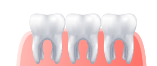 3 dientes en encia