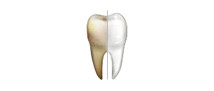 Dientes antes y después de profiplus