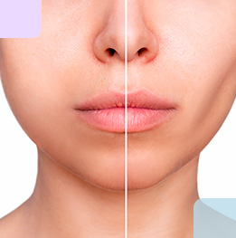 antes y después de cachetes de mujer después de la bichectomia